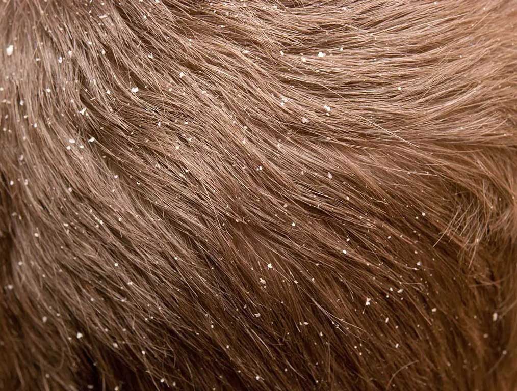 The 5 Severe Dandruff Causes And The Remedy To Know