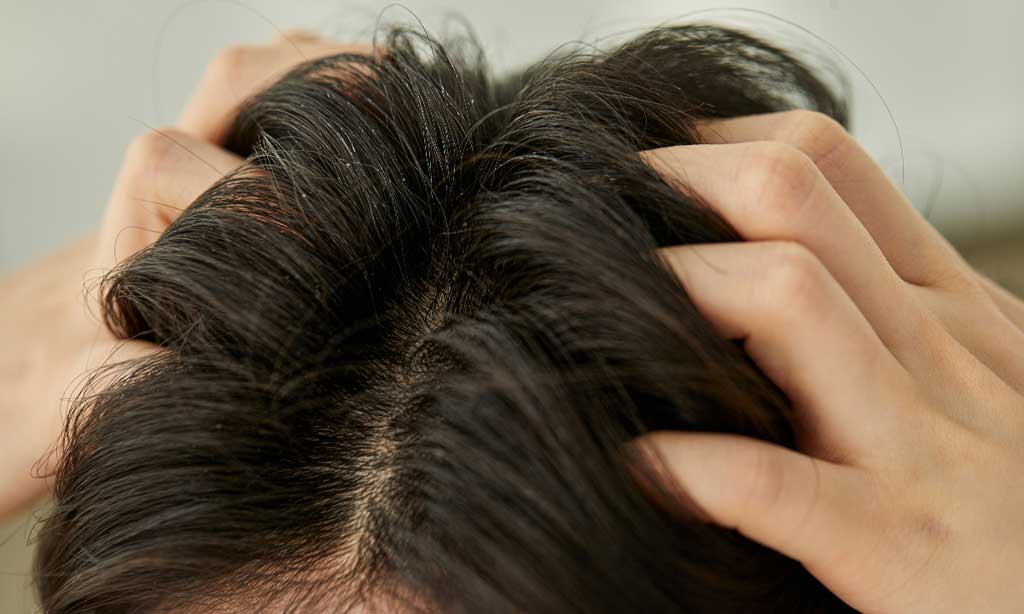 The 5 Severe Dandruff Causes And The Remedy To Know