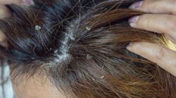 4 Must-Try Natural Severe Dandruff Removal to Get Rid of Dandruff