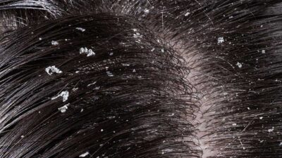 Dandruff Remedy At Home with Natural Treatments