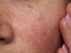 Itchy Acne On Face! How to Treat The Pesky Skin Inflammation?