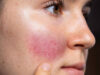 5 Vitamins For Rosacea! Know Your Skin Condition And Care!