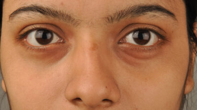 Dark circles got you down? Unlock the secrets of concealer and makeup magic to effortlessly transform your under-eye area and embrace a radiant, youthful glow—no sleep required!