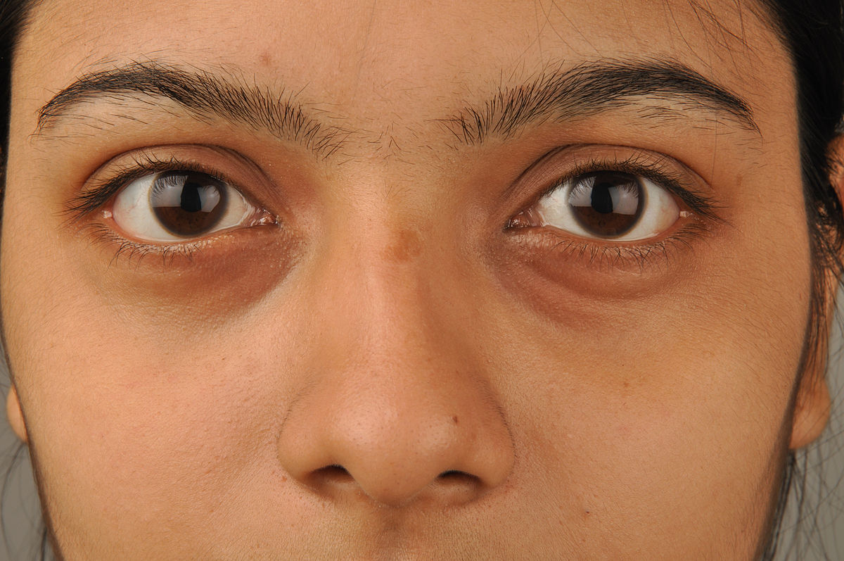 Dark circles got you down? Unlock the secrets of concealer and makeup magic to effortlessly transform your under-eye area and embrace a radiant, youthful glow—no sleep required!